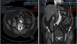 Tomography images showing infrarenal abdominal aortic aneurysm with mural thrombus, conical neck, and iliac angulation.