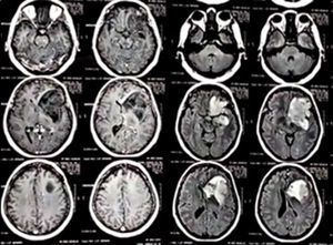 Magnetic resonance imaging showing evidence of frontal lesion.