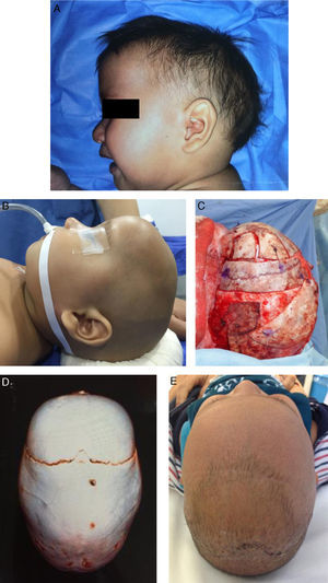 A 10-month old boy with sagittal craniosynostosis who underwent a total cranial vault remodeling based on the Melbourne method.39 (A) preoperative lateral view, (B) preoperative lateral view on table, (C) transoperative lateral view on table, after remodeling, (D) preoperative 3D CT, view from above, (E) postoperative view from above at 2-months follow-up.