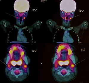 Initial FDG PET/CT where there is evidence of metabolic activity in level IIA bilateral cervical ganglia, with SUVmax 3.37.