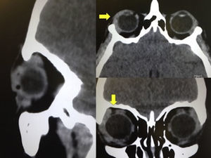 Control tomography after receiving one month of treatment with antibiotic therapy, where enlargement of the lower conjunctiva of the right eye (2.6mm thick) was in evidence.