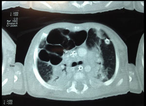 CT scan of the chest, multiple intrapulmonary air cysts in the middle lobe, anterior and basal segments of the lower lobe of the right lung lesions rounded morphology, the largest reported 32mm of diameter.