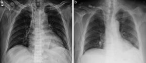 (a) Mahurkar catheter deviating towards the pleural cavity. (b) Lung re-inflated immediately after the surgery with some subcutaneous emphysema due to coughing at the start of the procedure. Insertion of another Mahurkar catheter after removing the one in the pleural cavity.
