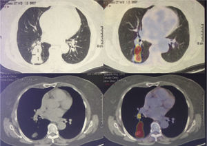 PET-CT with increased uptake (SUVmax 10.67) in posterior segment of right lower lobe with interlobar lymphadenopathy.