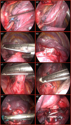 Stapling of interlobar incision RUL and RLL (A1 and A2). Stapling of RLL artery (B1 and B2). Stapling of RLL vein (C1 and C2). Stapling of RLL bronchus (D1 and D2).
