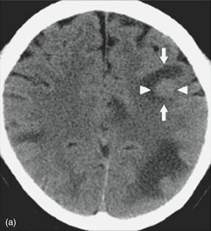 Axial cut of non-contrast CT brain scan showing an isodense image to the left frontal brain parenchyma marked with an arrow, as well as perilesional oedema corresponding to the hypodense image.