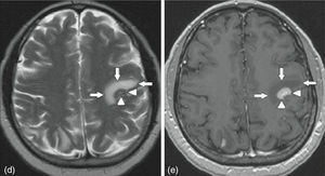 Axial cut of contrast MRI of the brain. On the left, T2-weighted image showing hyperintense left frontal region marked with arrows. On the right, T1-weighted image showing perilesional hypointensity and central hyperintensity of the left frontal region marked with arrows.