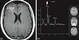 Spectroscopy of right frontal lesion marked with arrows on the image to the left; and the image to the right marked with the arrow shows an increase in choline representing the accelerated formation of cell membranes compatible with metastatic lesion.