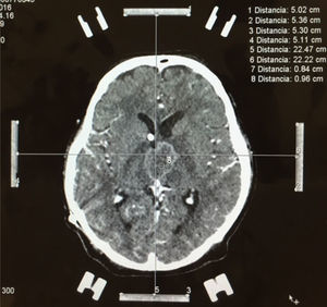 Stereotactic biopsy with ZD frame. Contrast-enhanced CAT image showing a thalamic tumour lesion, calculating coordinates for stereotactic-guided biopsy sampling.