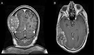 Magnetic resonance of the brain, T1-weighted sequence image with contrast. A shows the coronal cut and B the axial cut, with the presence of a hyperintense image in the right parietal–temporal–occipital with bone infiltration and displacement of brain parenchyma.