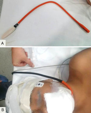 (A) Construction of oesophageal stethoscope with a Nelaton catheter, fixating the finger of a glove to its distal end with silk suture. (B) Proximal portion of the Nelaton catheter connected to conventional stethoscope tube after removal of the diaphragm.