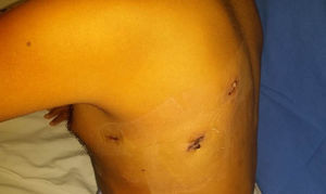 Incisions 20h after surgical procedure.