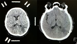 Contrast-enhanced CT scan of the left side of the brain showing stereotactic frame and fiducials; contrast medium enhancement of left parietal region showing tumour lesion with considerable perilesional oedema. Follow-up non-contrast CT scan of the right side of the brain showing total resection of the lesion with hypodense image denoting gliosis in left parietal lobe.