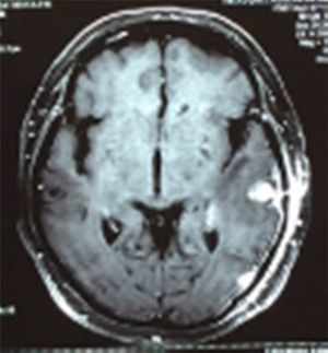MRI T1-contrast: axial cut showing a new, relapsing cortical lesion with hard implantation in left temporal lobe, homogeneous contrast medium enhancement and perilesional oedema.