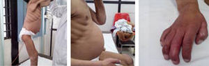 Physical examination findings in a patient with MPS II: grade III malnutrition; coarse facial features; obese abdomen with umbilical hernia; restricted joint extension; and claw hand.