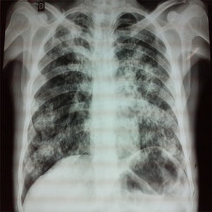 Chest X-ray. Posteroanterior projection showing diffuse, bilateral reticulonodular infiltrates.