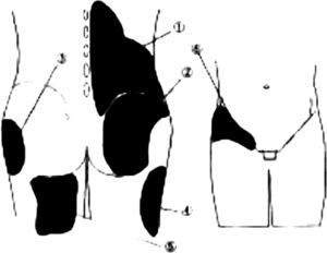 Areas of referred pain. Image representative of the most affected areas. (1) Vertebral and paravertebral low back up to anterior–superior iliac spine. (2) Region of the gluteus maximus and minimus. (3) Lateral region of the gluteus. (4) Posterior and lateral surface of the thigh. (5) Medial region of the posterior surface of the thigh. (6) Region of anterior inguinal fold, anterior iliac spine up to pubic symphysis.