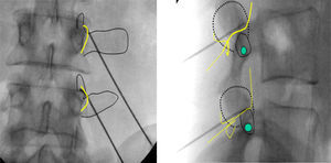 Fluoroscopic monitoring in AP and lateral projection during electrode insertion and relationship to the posterior ramus. AP lumbar X-ray. Yellow line: superior articular facet; thin black lines: transverse apophyses and upper part of superior facet in articulation with inferior facet of superior vertebra; thick black line: thermocoagulation electrode. Lateral X-ray. Green spot marks area to be lesioned with electrocauterisation, level of passage of the nerve, with exit through intervertebral foramen.
