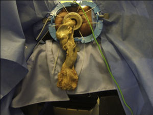Transanal excision of the specimen.