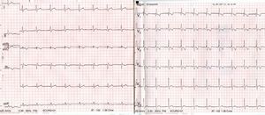 ECG on the patient's arrival at the emergency department showing sinus rhythm with new pattern of incomplete right bundle branch block with obvious changes in repolarisation not present on the baseline ECG.