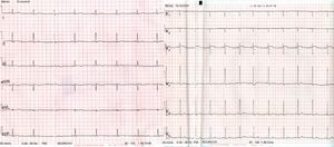 ECG after 2 days of the patient's clinical course showing sinus rhythm and correction of the pattern of right bundle branch block.