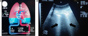 Patient with ARDS with continuous haemodynamic monitoring, where: (A) an increased extravascular lung water index (ELWI) is observed compared to (B) lung ultrasound showing a B pattern (black arrows). Database, ICU, Hospital Juárez de México, 2016.