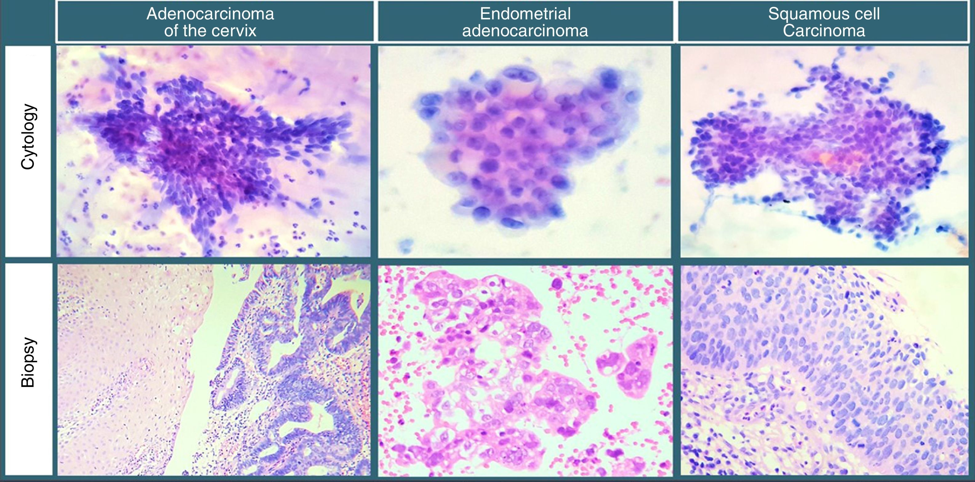 Cytological Diagnosis Of Cervical Adenocarcinoma And Cytohistological Cytological Diagnosis Of Cervical Adenocarcinoma And Cytohistological