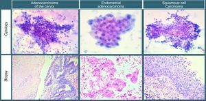 Examples of cases diagnosed as adenocarcinoma by cervicovaginal cytology (above) and their corresponding biopsies (below).