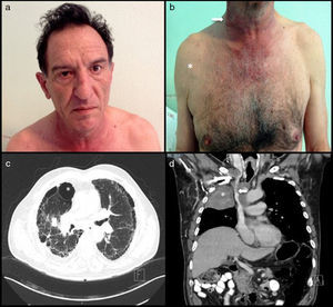 A 57-year-old man and chronic smoker with bullous emphysema and Horner's syndrome. (a) Eyelid pseudoptosis and mild oedema on the right half of the face. (b) Neck vein distension (arrow) and collateral venous network with oedema in the right hemithorax (asterisk). (c) Lung parenchyma with subpleural bullae and septal thickening (asterisk). (d) SVC compression (arrow) due to a right-side Pancoast tumour (asterisk).