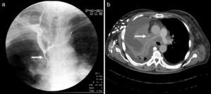 A 56-year-old man diagnosed with lung adenocarcinoma. (a) Cavography with obstruction of more than 90% of the SVC (arrow). (b) Chest CT scan with obstruction of the SVC (arrow) and occlusion of the right branch of the pulmonary artery due to extrinsic compression.