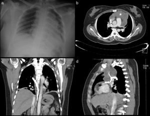 A 20-year-old woman diagnosed with diffuse large B-cell non-Hodgkin lymphoma. (a) Chest X-ray with a widened mediastinum. (b) Obstruction of the SVC (arrow) due to an anterior mediastinal tumour (star). (c and d) Obstruction of the SVC below the azygos (arrows).