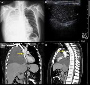 A 34-year-old man diagnosed with metastasis to the mediastinum by a testicular germ cell tumour. (a) Chest X-ray with opacity in the right hemithorax. (b) Testicular ultrasound with multiple nodules, some calcified. (c and d) CT cavography with obstruction of the SVC above the azygos (arrows).