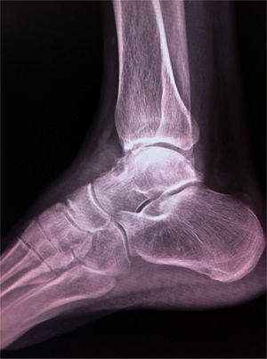 Lateral X-ray of the tibio-astragalin joint, with an osteolytic lesion in the talus, well limited and surrounded by an area of sclerosis.