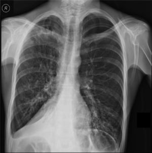 X-ray chest shows right posterior basal segmental atelectasis, the lungs present diffuse interstitial reticulum infiltrates, inflammatory infiltrates in the left lung base, bronchiectasis in principal and segmental bronchi, associated right pleural effusion. In addition, right subdiaphragmatic intestinal loops (Chilaiditi syndrome).