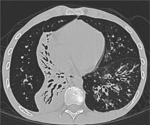 Computed tomography of the chest, axial section with a window for pulmonary parenchyma in which atelectasis with mucus impaction is observed in the lower right lobe (segments 7, 8 and 10). Cystic bronchiectasis with mucus impaction in the left lower lobe (segments 9 and 10).