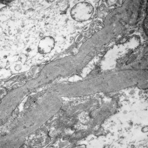 Segments of glomerular basement membrane from a case with Alport syndrome seen by electron microscopy at higher magnification. It shows splitting and multilamination with a classic “weave” or “basket-like” appearance; it also contains microparticles “in bread crumbs”. TEM, 20,000×.