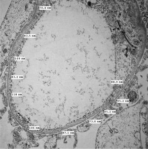 Same case as the previous image. In the transmission electron microscopy study, a homogeneously thinning glomerular basement membrane was observed, below 200nm. EM, 12,000×.