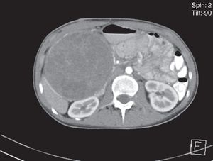 Abdominal computed tomography (axial plane, arterial phase): showing a mixed mass at the head of the pancreas.