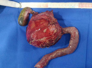 Result of the resection by classic Whipple procedure (case 1).