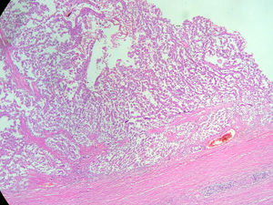 Haematoxylin and eosin staining: showing pseudopapillae coated by monomorphic, cubic cells and blood vessels.
