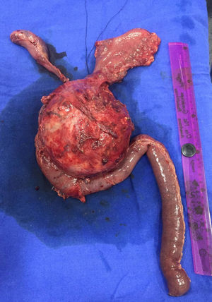 Result of the resection by pylorus-preserving Whipple procedure (case 2).