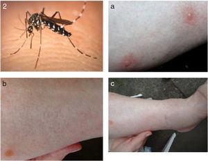 Aedes albopictus dermatitis and treatment effects. (a) Mosquito and acute vesicular dermatitis. (b and c) Drying of vesicles and disappearance of lesion after treatment with GHGS.