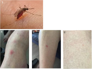 Culex pipiens effects and treatment with GHS gel. Top: mosquito. (a–c) Acute and post-treatment lesion.
