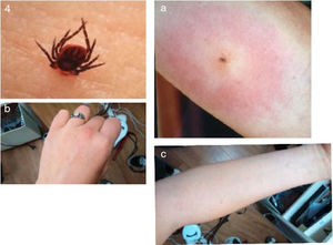 Ixodes ricinus tick bites and treatment. Top and (a, b) tick and acute bite.