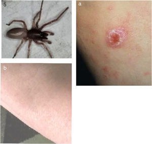 European biting spider (suspected Wolf spider) and treatment. Top and (a) spider and acute lesion, (a and b) residual slight skin pigmentation after treatment. Lesion with exanthema migraines. (c) Treatment effects with GHSG.