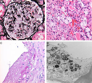 Vacuolation and deposition of Gb3 in Anderson–Fabry disease. (A) Vacuolation of podocytes. (B) Tubular and interstitial deposits. (C) Deposits in blood vessels. (D) EM: zebra bodies in the cytoplasm of podocytes.