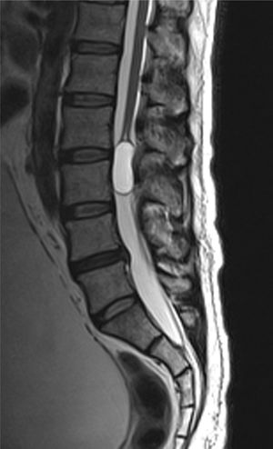 T2 axial MRI showing the heterogeneous cystic image with defined borders at L3 and the lower edge of L2.