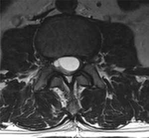 T2 axial MRI at the level of the tumour lesion, showing it to be heterogeneous with a hyperintense, cystic major component in the centre, hypointense periphery and delimited borders, dorsally displacing the cauda equina.