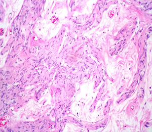 Histopathological image with haematoxylin and eosin stain, identifying irregular peripheral nerve bundles interspersed with small islands of central nervous tissue.