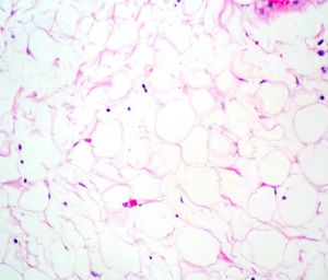 Another element found was adipose tissue with a mature appearance characterised by the presence of large cells with a single clear intracytoplasmic vacuole and a flattened nucleus displaced towards the periphery.